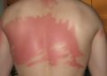 Artificial intelligence diagnoses skin cancer with the precision of a dermatologist