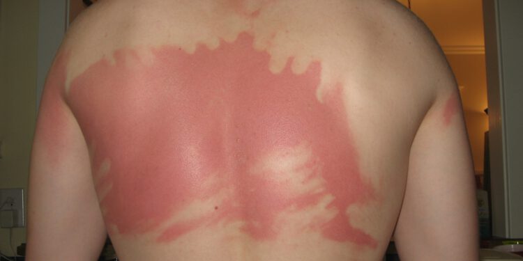 Artificial intelligence diagnoses skin cancer with the precision of a dermatologist